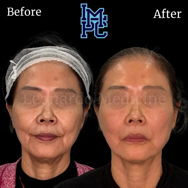 APTOS® Thread Lift case 1