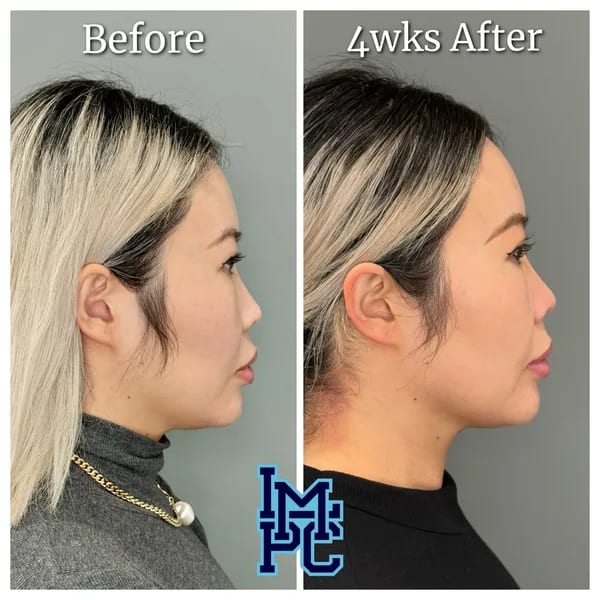 APTOS® Thread Lift case 10