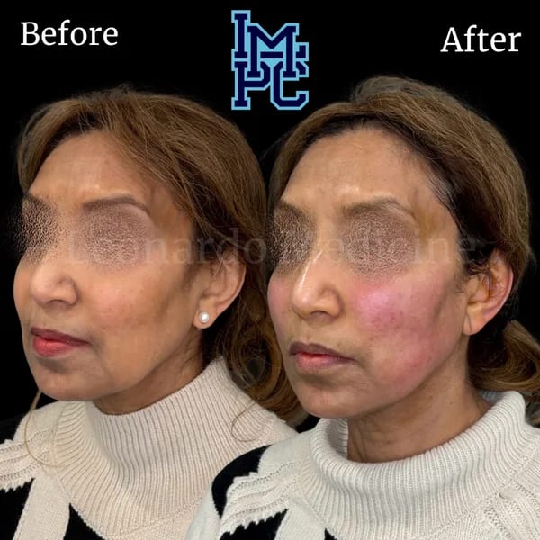 APTOS® Thread Lift case 11