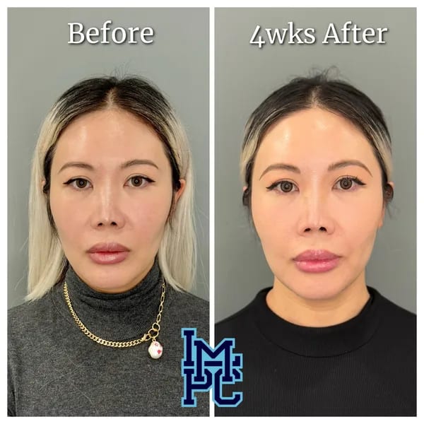 APTOS® Thread Lift case 12