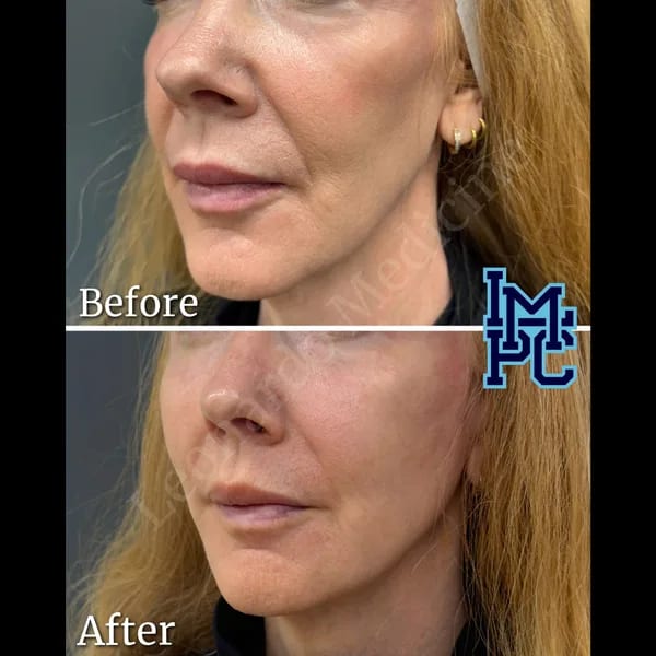 APTOS® Thread Lift case 13