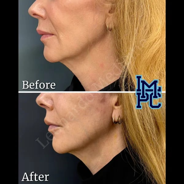 APTOS® Thread Lift case 14