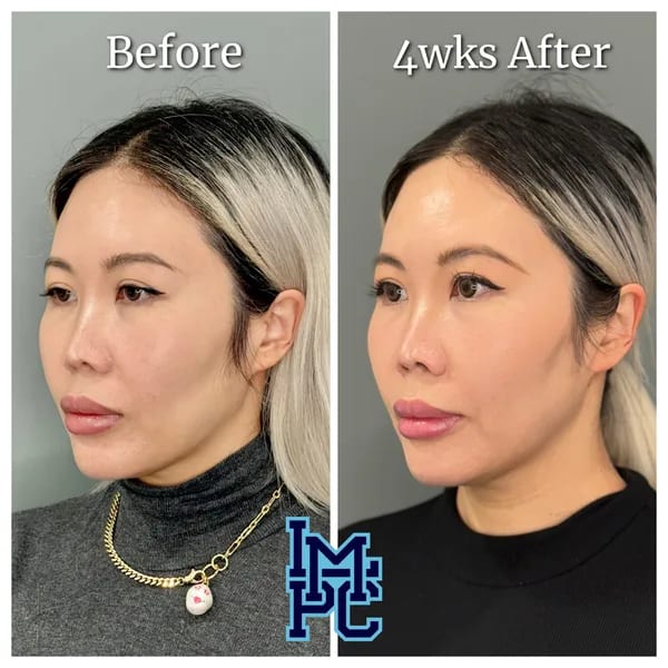 APTOS® Thread Lift case 15