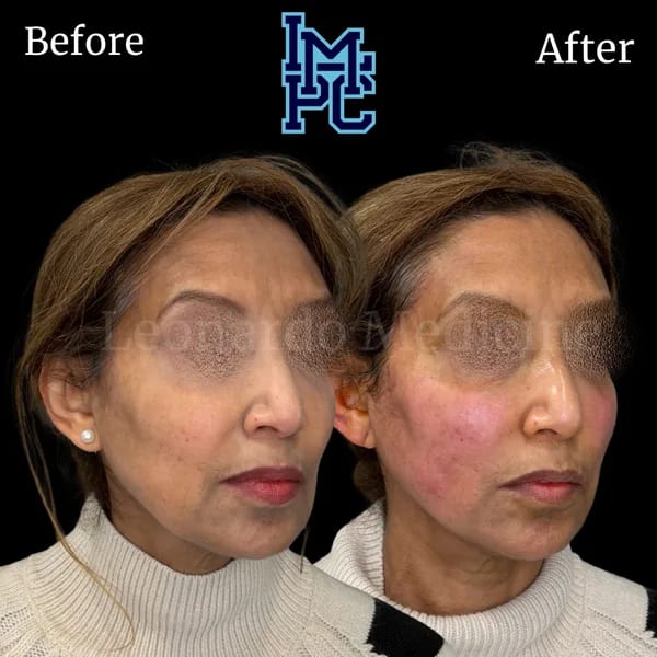 APTOS® Thread Lift case 16