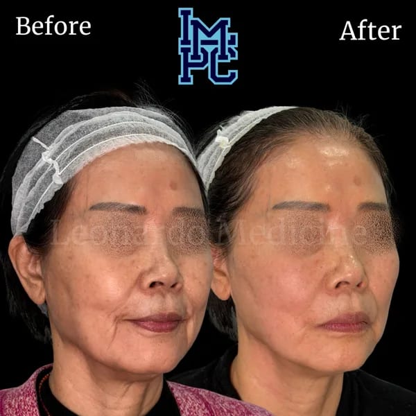 APTOS® Thread Lift case 17