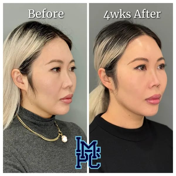 APTOS® Thread Lift case 18