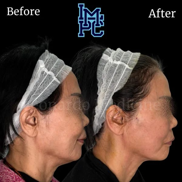 APTOS® Thread Lift case 2