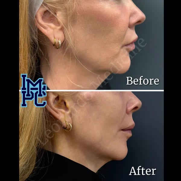 APTOS® Thread Lift case 3