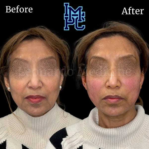 APTOS® Thread Lift case 4