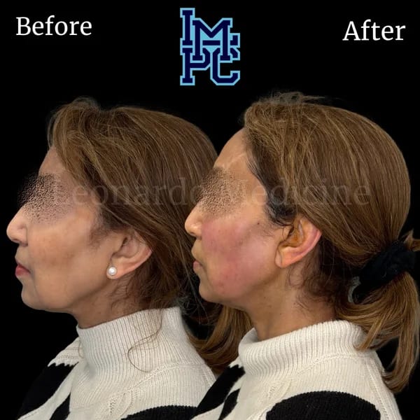 APTOS® Thread Lift case 5