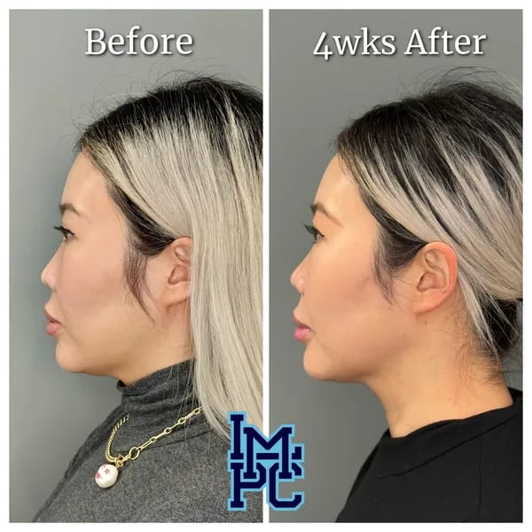 APTOS® Thread Lift case 6