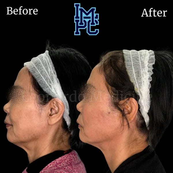 APTOS® Thread Lift case 8