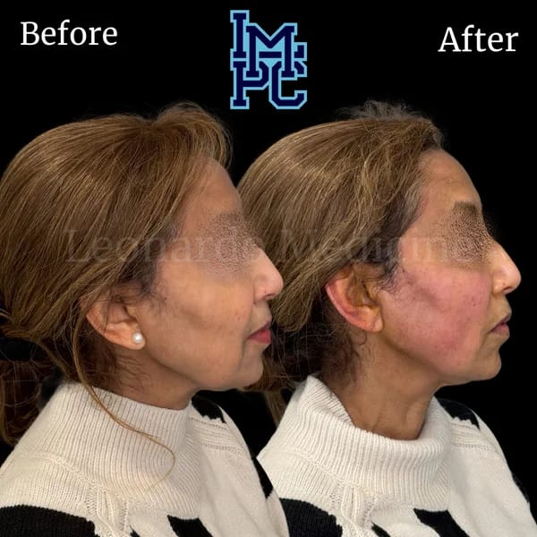 APTOS® Thread Lift case 9