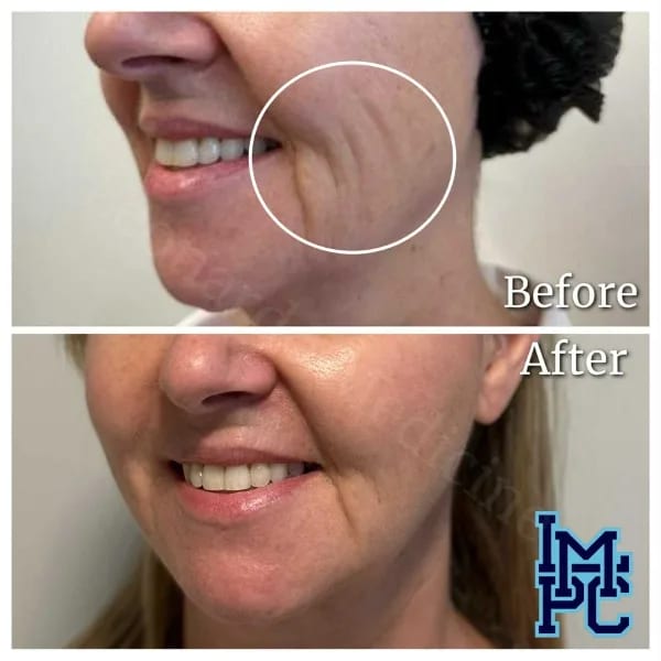 Dilute Radiesse case 11