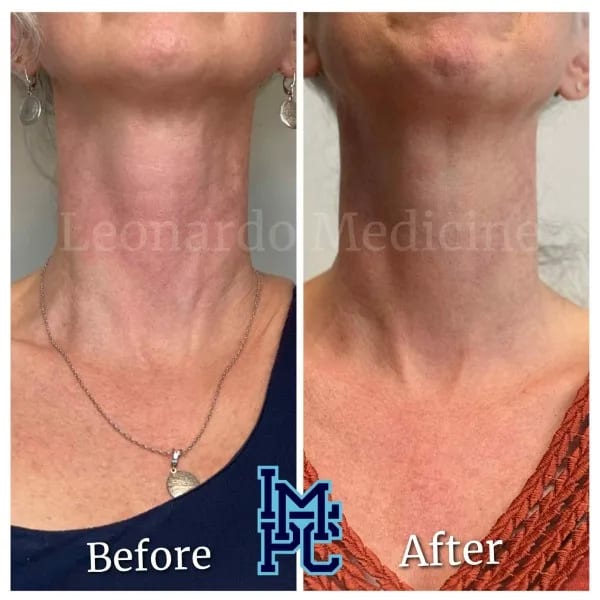 Dilute Radiesse case 14