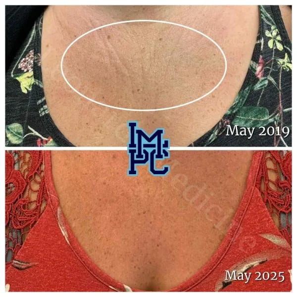 Dilute Radiesse case 15