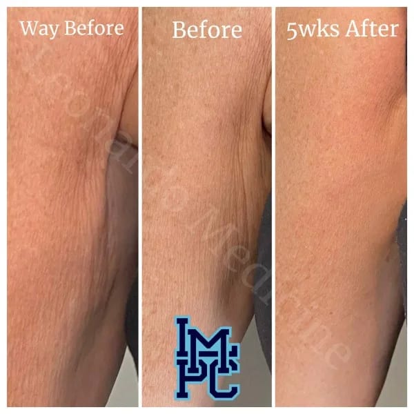 Dilute Radiesse case 17