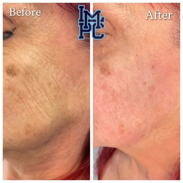 Dilute Radiesse case 4