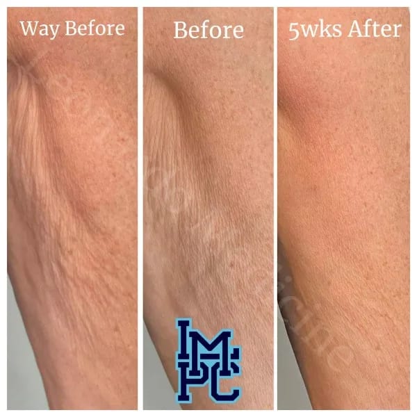 Dilute Radiesse case 7