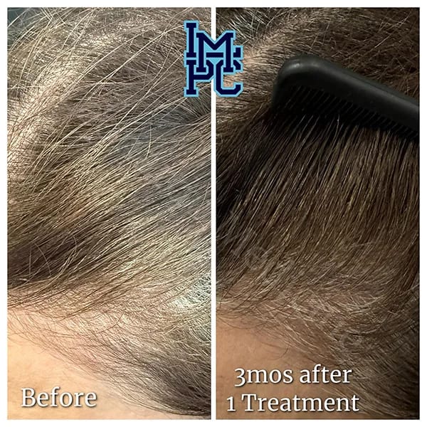 Needleless Hair case 11