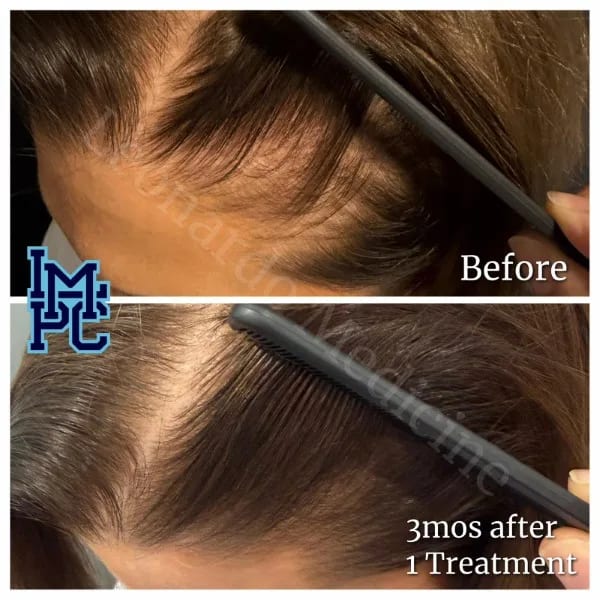 Needleless Hair case 17