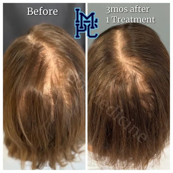 Needleless Hair case 18