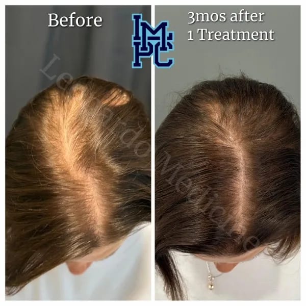 Needleless Hair case 19