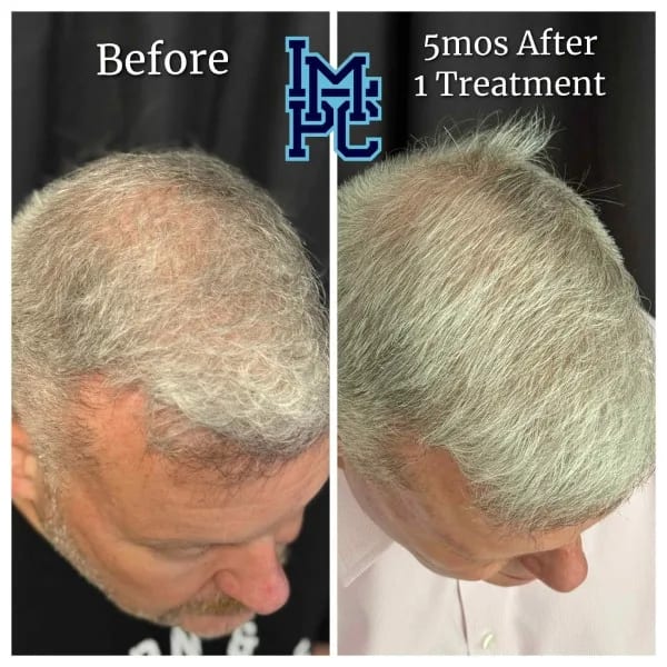 Needleless Hair case 2