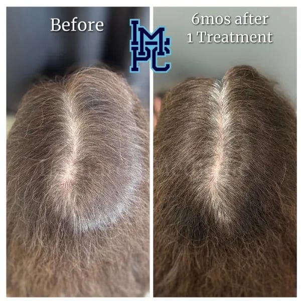 Needleless Hair case 23