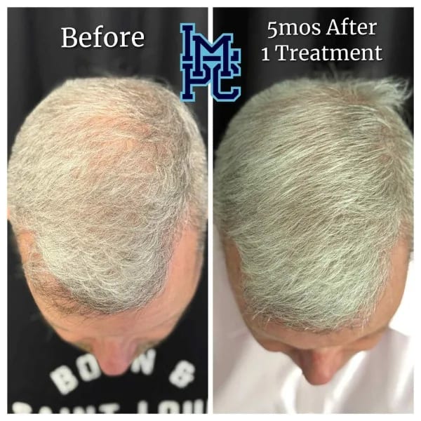 Needleless Hair case 3