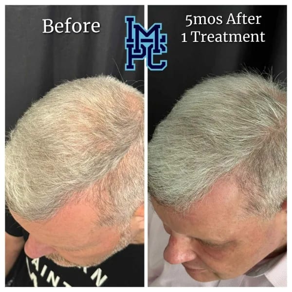 Needleless Hair case 5