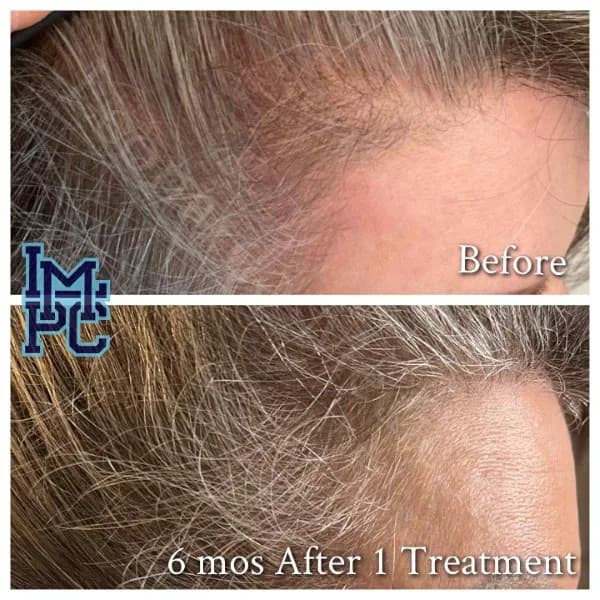 PRP Hair Treatment case 2