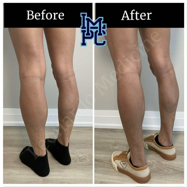 Body Tox treatment 2