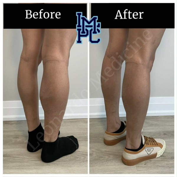 Body Tox treatment 4