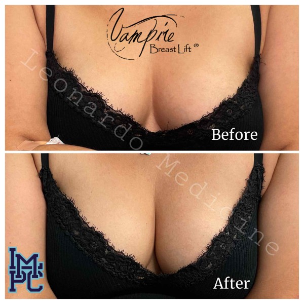 Vampire Breast Lift treatment 1