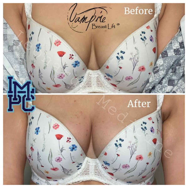Vampire Breast Lift treatment 2