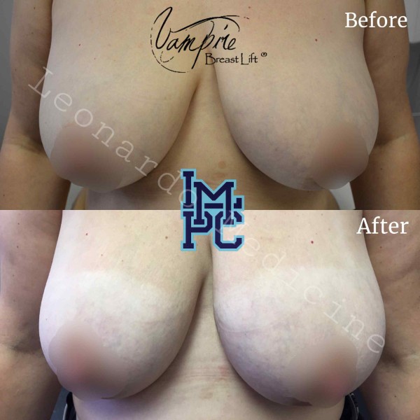 Vampire Breast Lift treatment 3