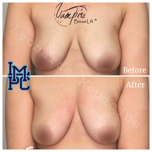 Vampire Breast Lift treatment 5