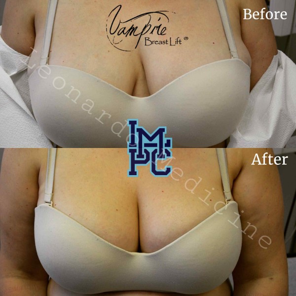 Vampire Breast Lift treatment 6