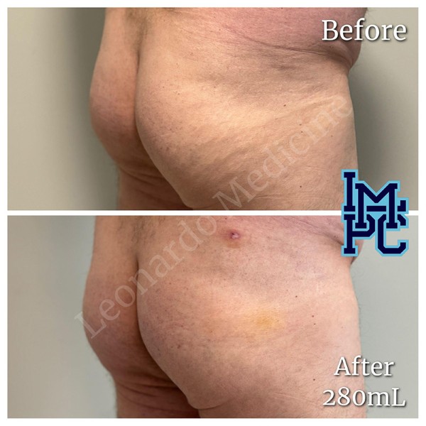 Butt Lift treatment 1