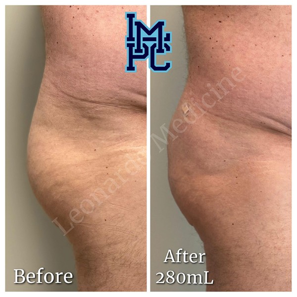 Butt Lift treatment 10