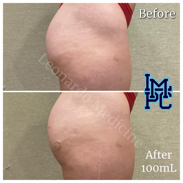 Butt Lift treatment 13