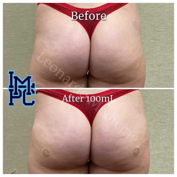 Butt Lift treatment 14