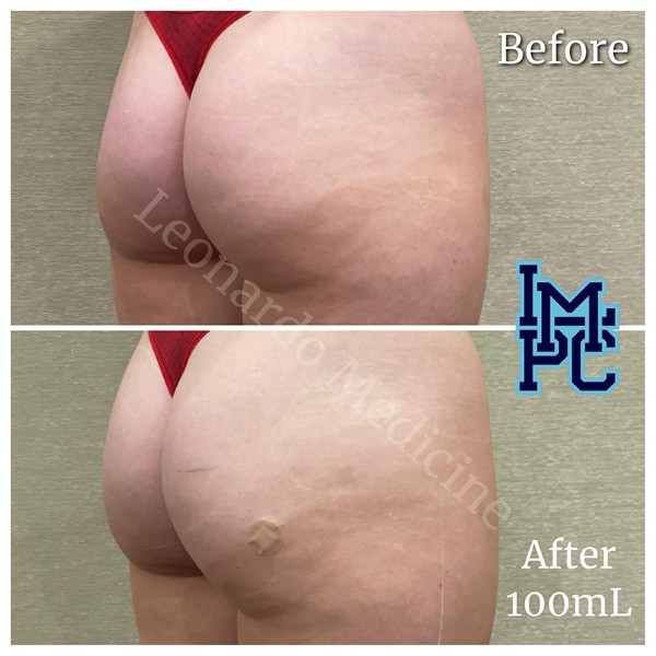 Butt Lift treatment 15