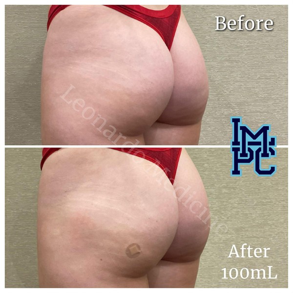 Butt Lift treatment 16