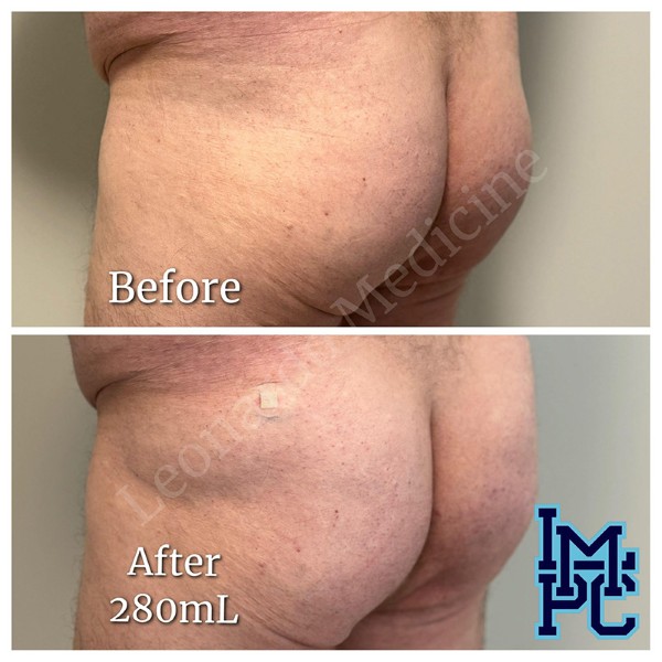 Butt Lift treatment 17