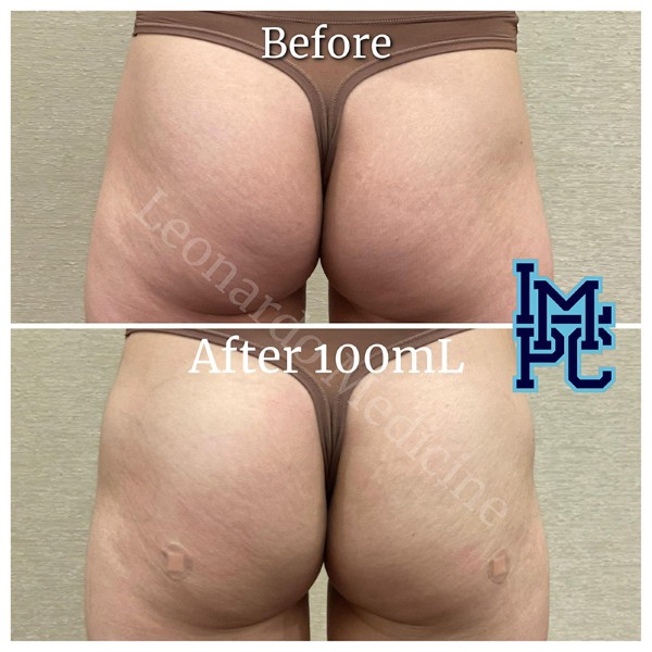 Butt Lift treatment 18