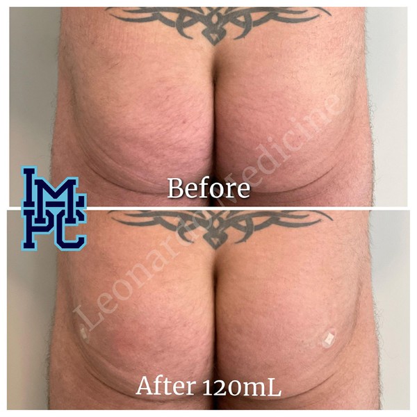 Butt Lift treatment 19