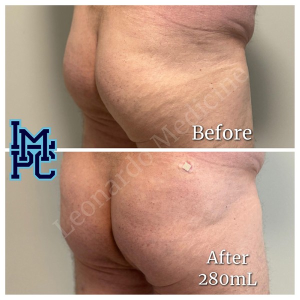 Butt Lift treatment 20