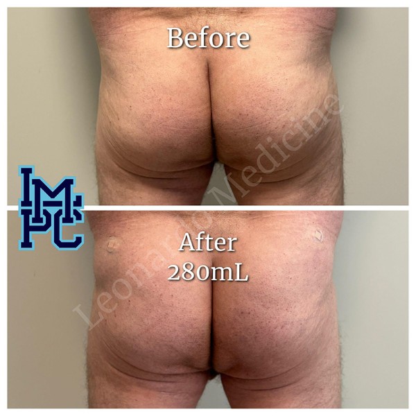 Butt Lift treatment 22
